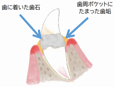 よごれた歯のイラスト.png